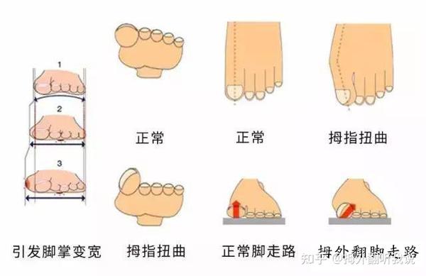 脚拇指外翻最新治疗技术揭秘